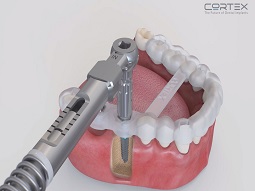  הפקת סרטון הדרכה לחברת קורטקס שתלים דנטליים